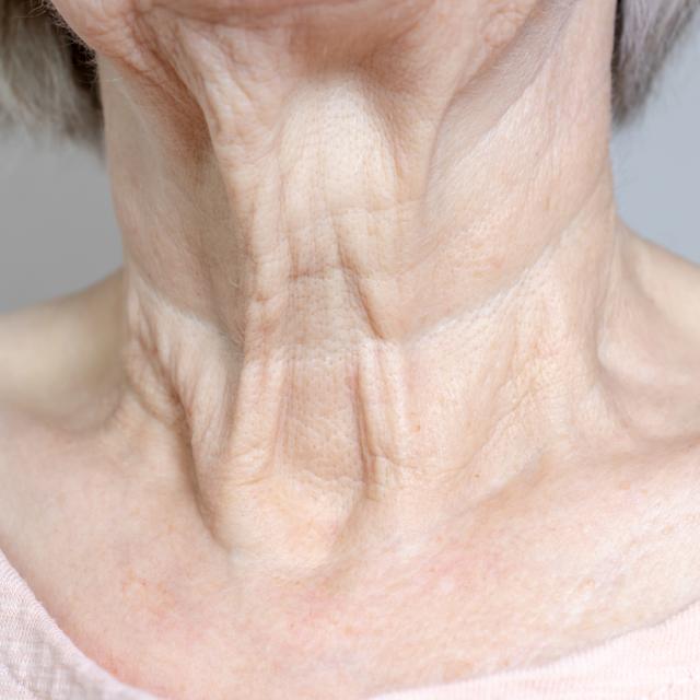 575: Turkey Neck November: How to Avoid Platysmal Bands, Crepey Skin, and Sagging - podcast episode cover