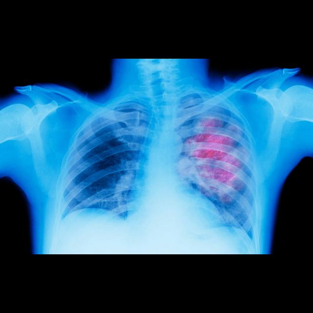Lung Cancer Screen Could Be Easy Pee-sy - podcast episode cover