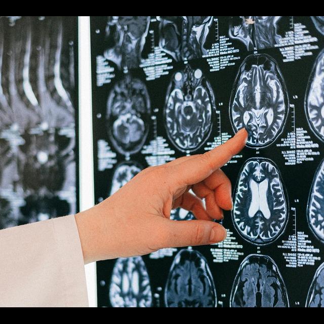 The Basics of Dementia - podcast episode cover