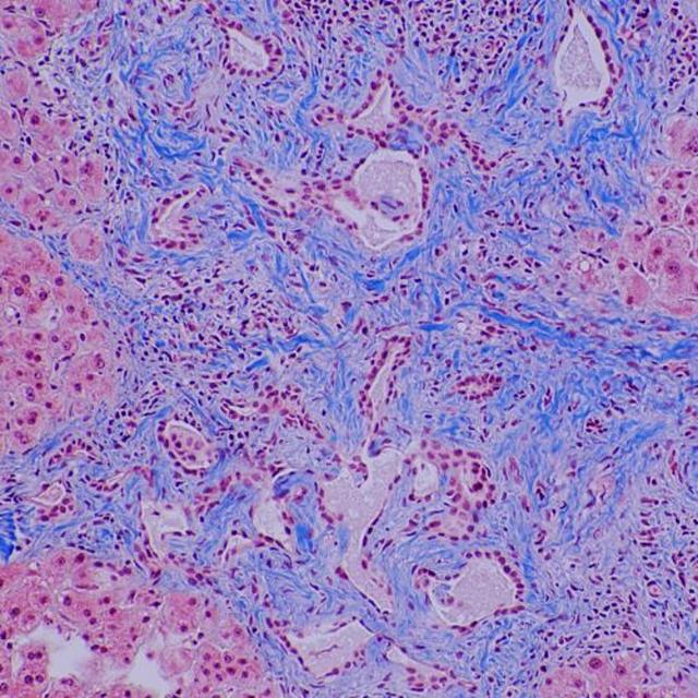 OCTalks: targeting FGFR2 in advanced cholangiocarcinoma - podcast episode cover