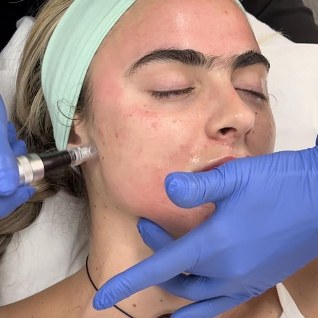 669: Advanced Microneedling Techniques for Skin Rejuvenation - podcast episode cover