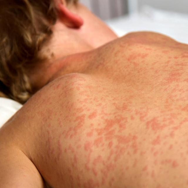 Canada has a measles problem - podcast episode cover