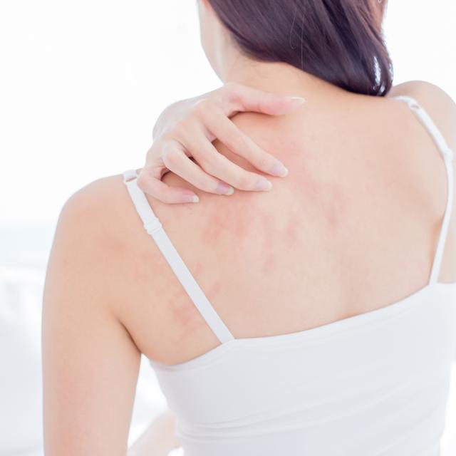590: Frosty Flare-Ups: Your Guide to Eczema-Free Winter Skin! - podcast episode cover