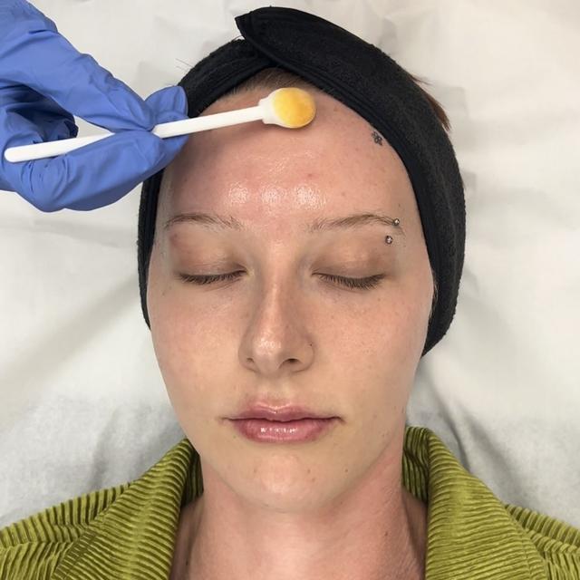605: Chemical Peels to Jumpstart Spring! - podcast episode cover