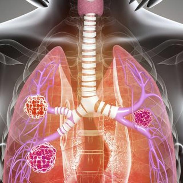 Why is personalised medicine vital to managing lung cancer? - podcast episode cover